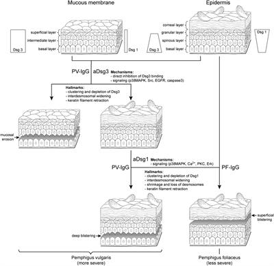 Pemphigus—A Disease of Desmosome Dysfunction Caused by Multiple Mechanisms